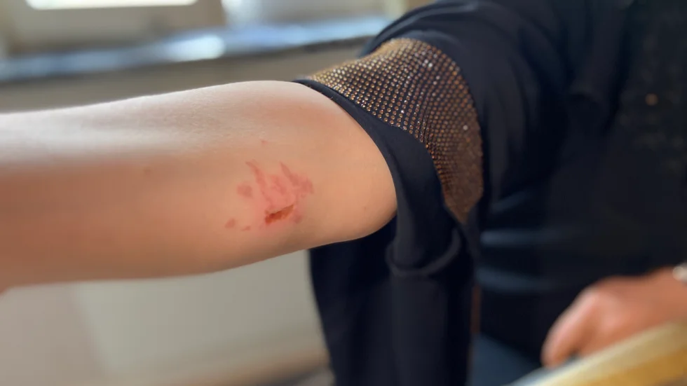 Kysaa Mashoud visar upp skadan på sin arm. Hon berättar att hon brände sig på elden när hon försökte släcka lågorna med ett täcke.